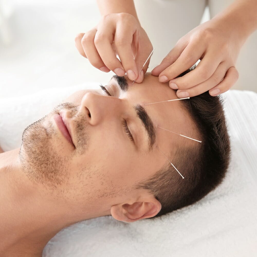 Mann får akupunktur behandling av hodeplager