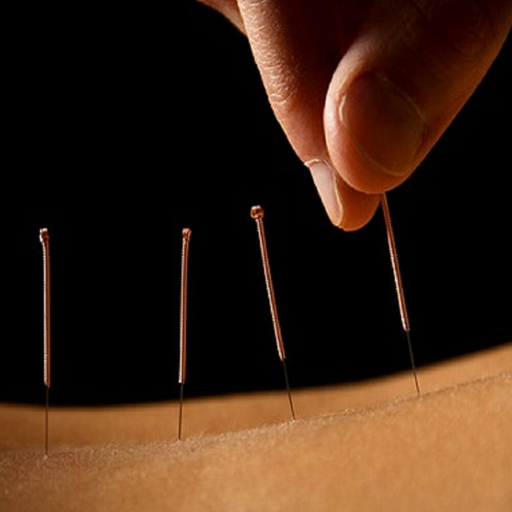 Akupunktur behandling for ryggplager